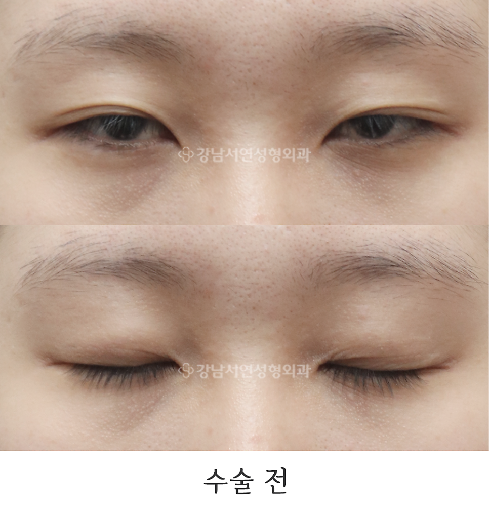 눈매 트임 수술 전 사진