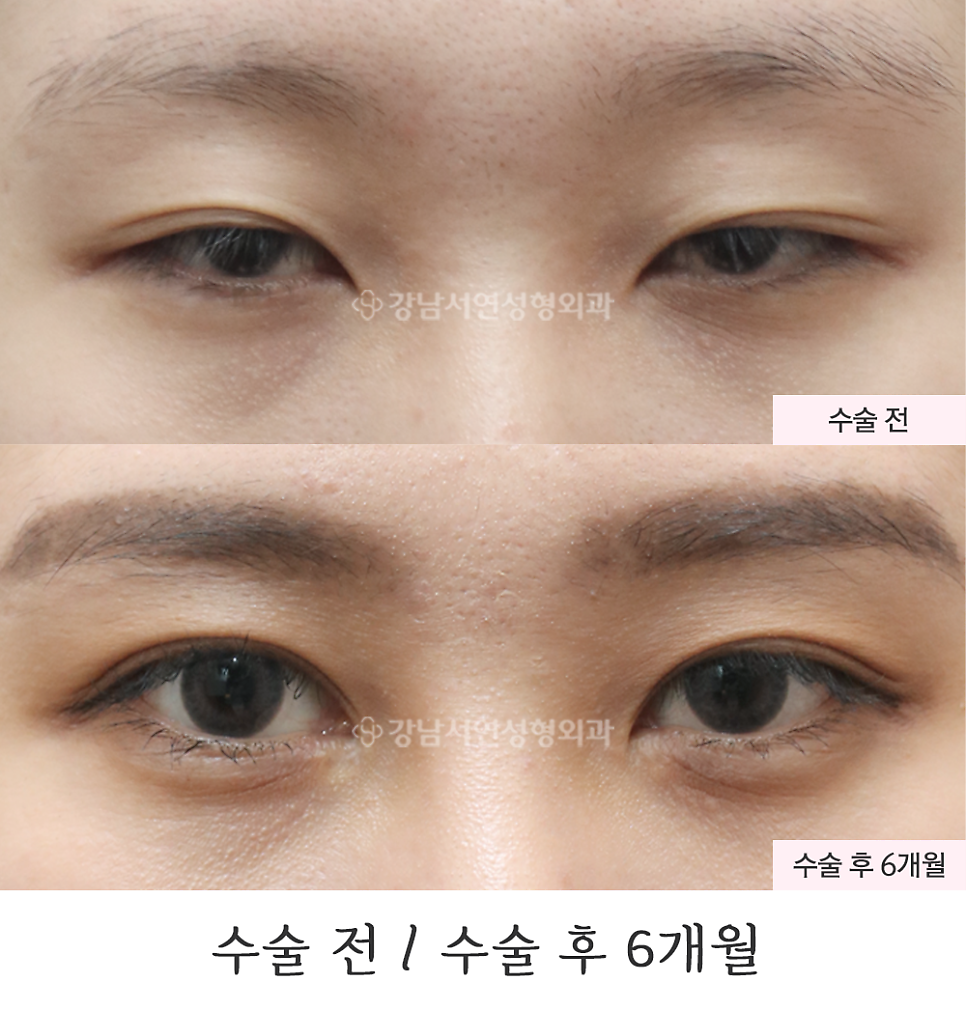 눈매 트임 수술 전후 비교 사진