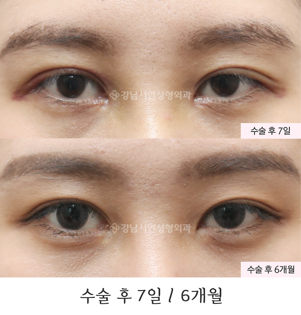 눈매 트임 수술 전후 비교 사진