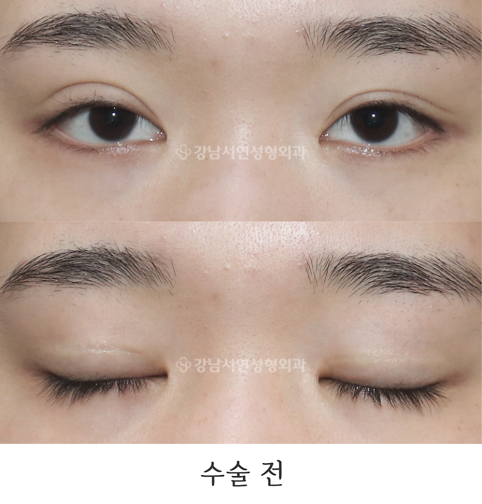쌍꺼풀 재수술 전 사진