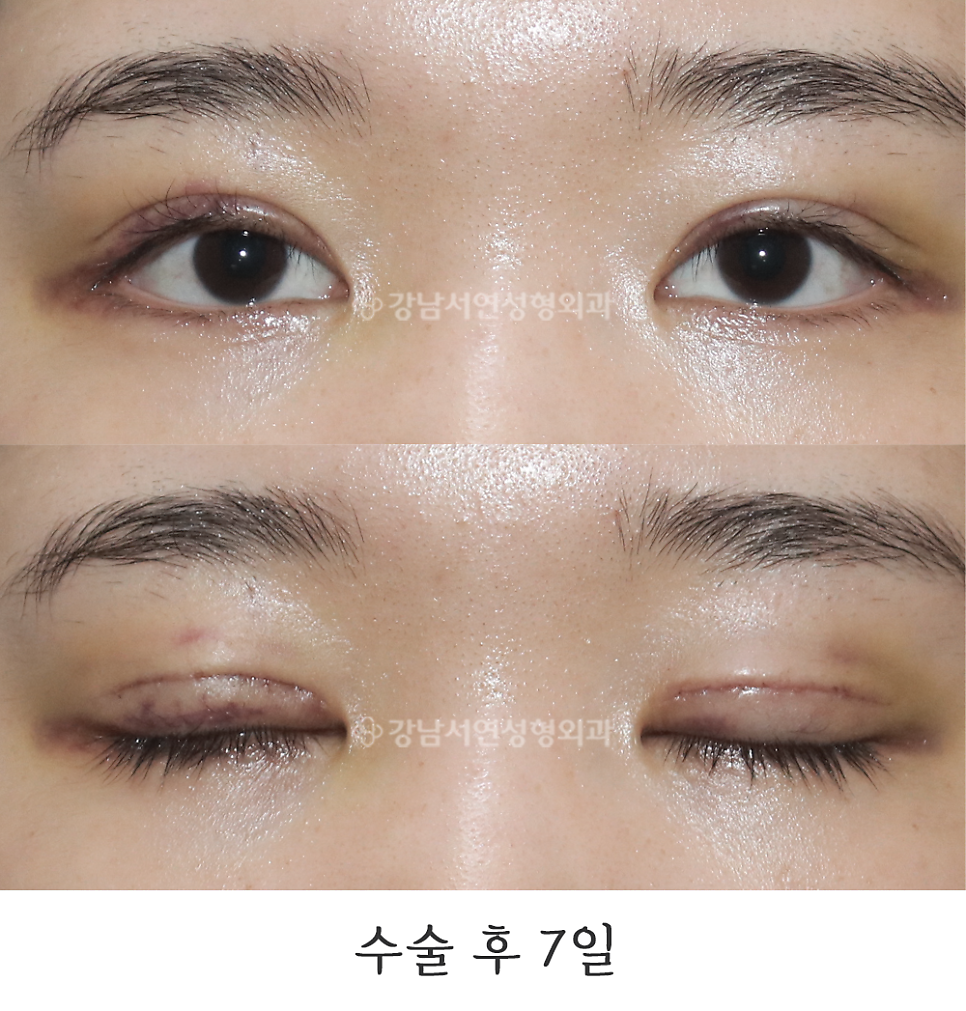 쌍꺼풀 재수술 후 사진