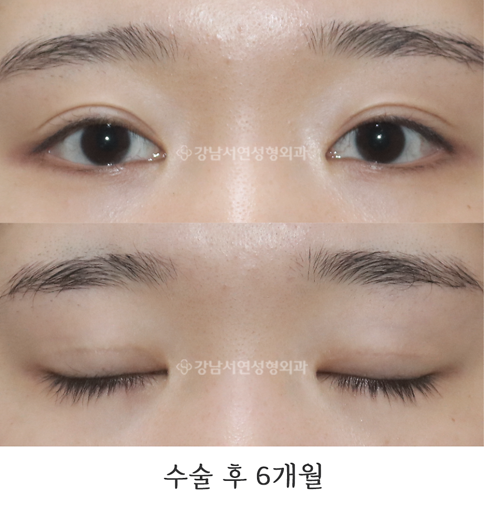 쌍꺼풀 재수술 후 사진