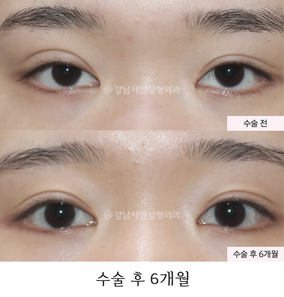 쌍꺼풀 재수술 전후 비교 사진