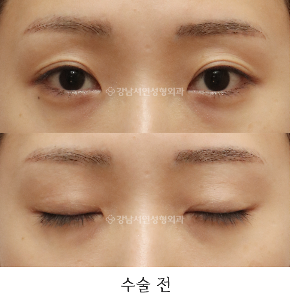 쌍꺼풀 재수술 전 사진