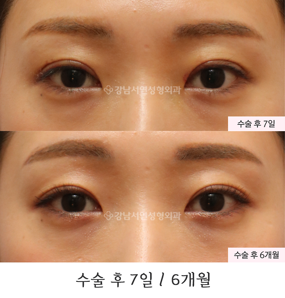 쌍꺼풀 재수술 전후 비교 사진