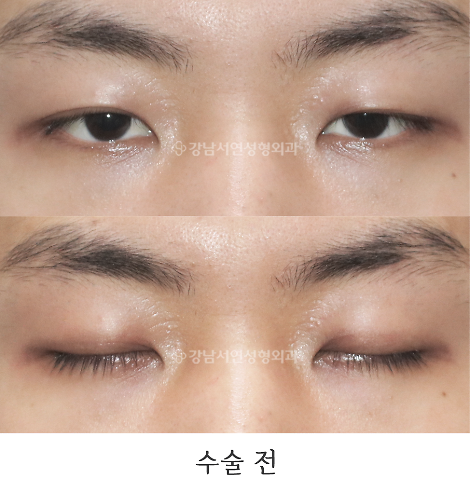 남자 눈성형 수술 전 사진