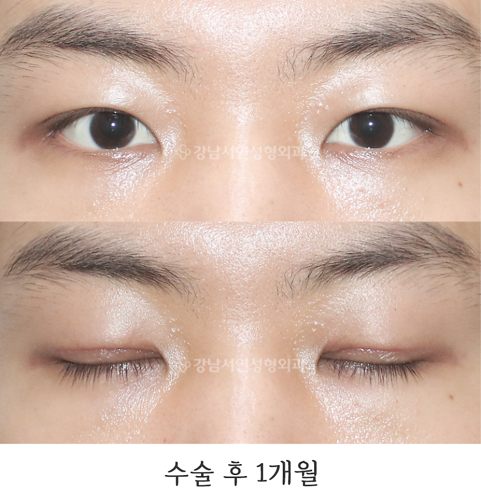 남자 눈성형 수술 후 사진