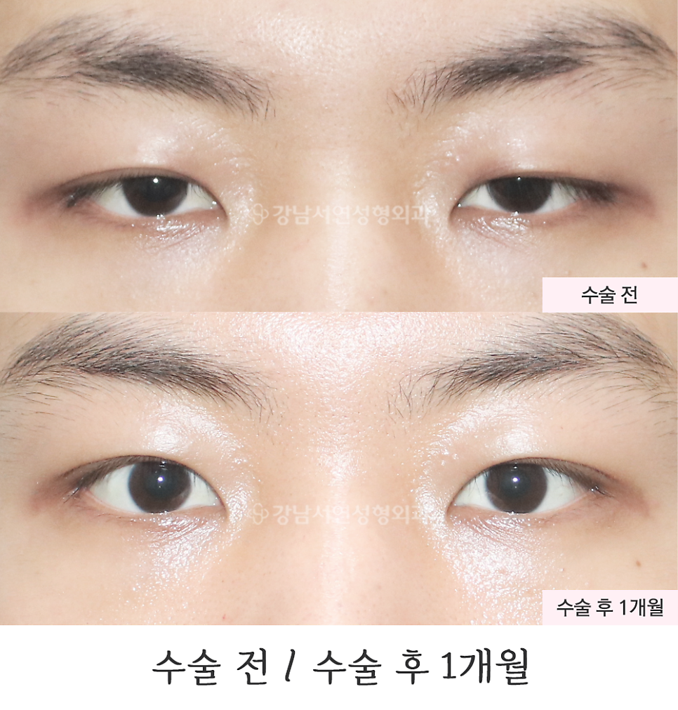 남자 눈성형 수술 전후 비교 사진