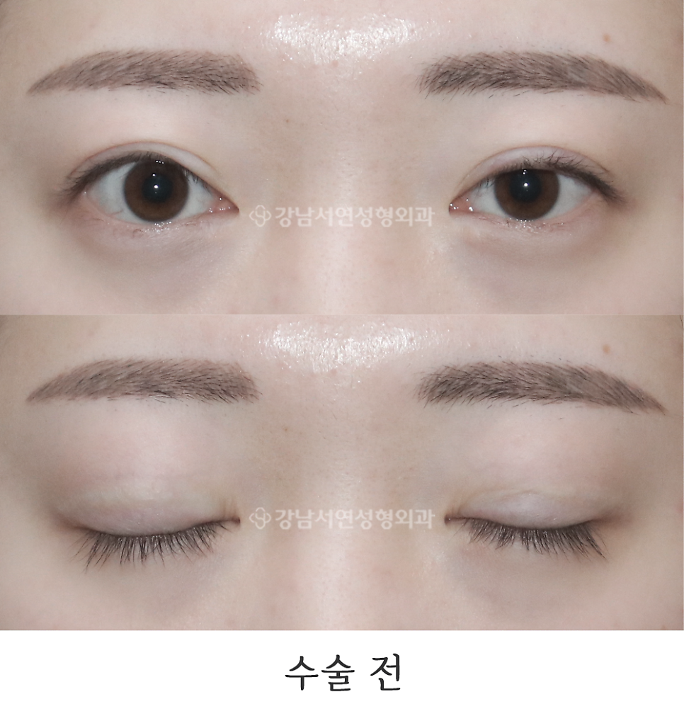 두줄따기 수술 전 사진