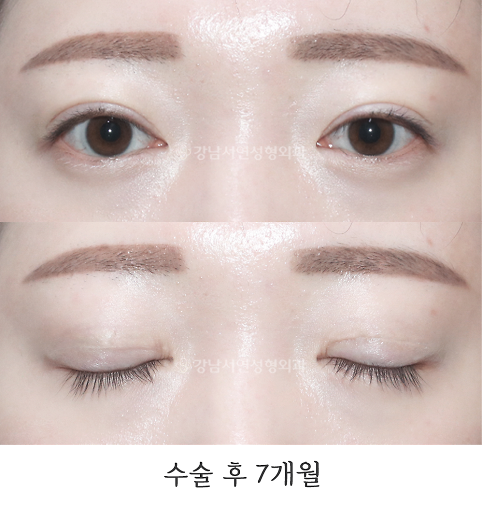 두줄따기 수술 후 사진