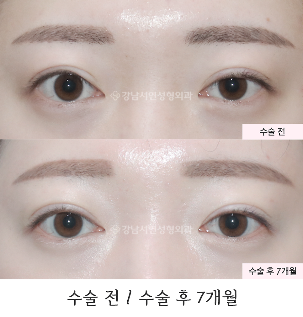 두줄따기 수술 전후 비교 사진