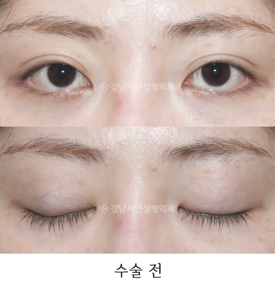 쌍꺼풀 재수술 전 사진