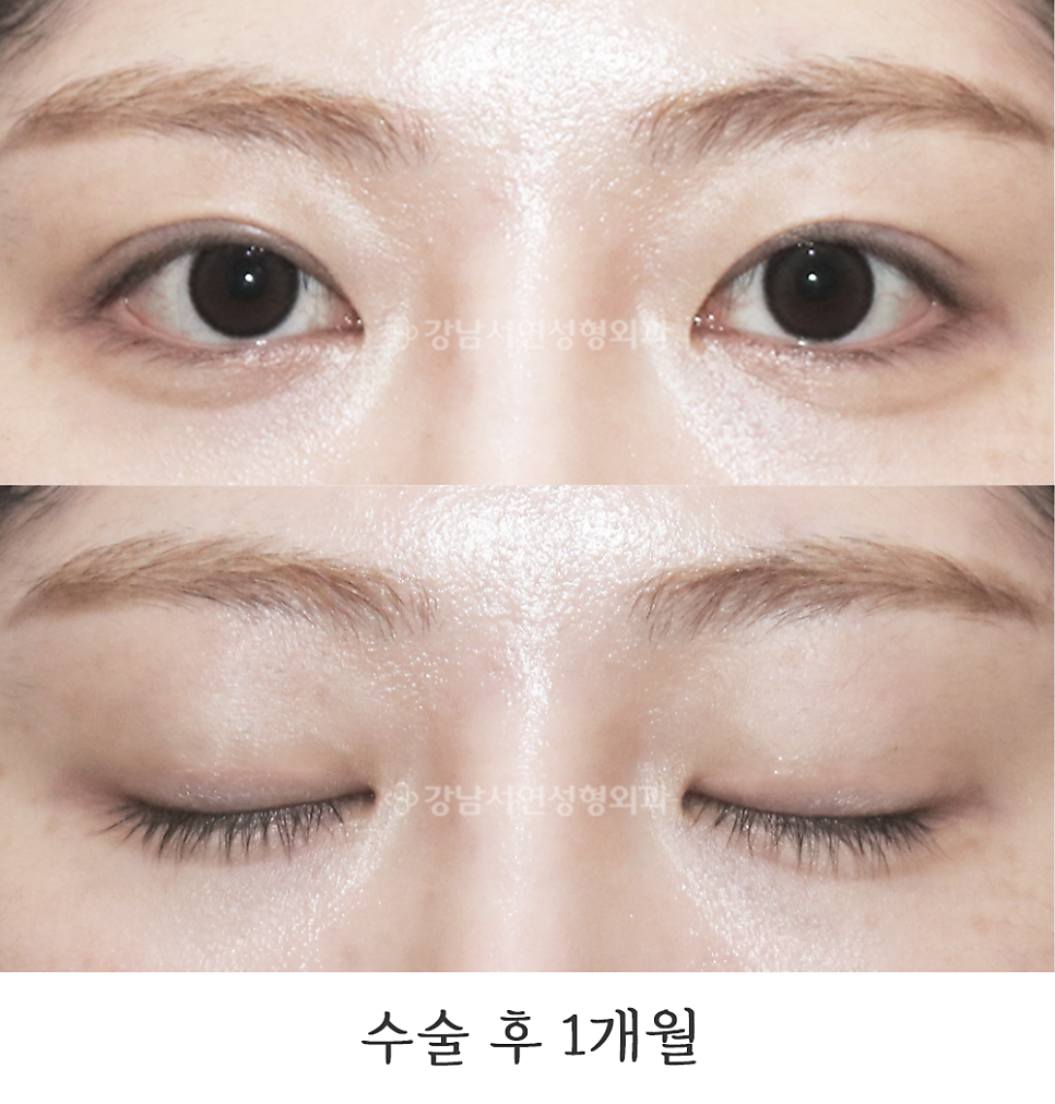쌍꺼풀 재수술 후 사진