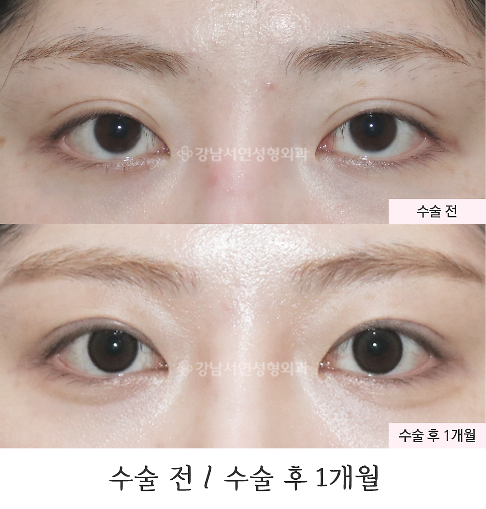 쌍꺼풀 재수술 전후 비교 사진
