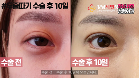 두줄따기 수술 전후 비교 사진