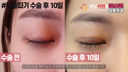 두줄따기 수술 전후 비교 사진