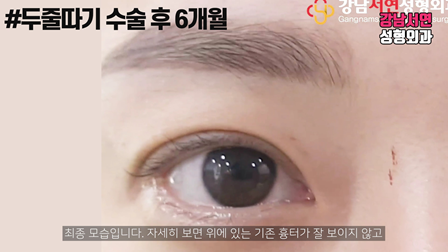 두줄따기 수술 후 사진