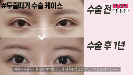두줄따기 수술 전후 비교 사진