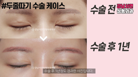 두줄따기 수술 전후 비교 사진