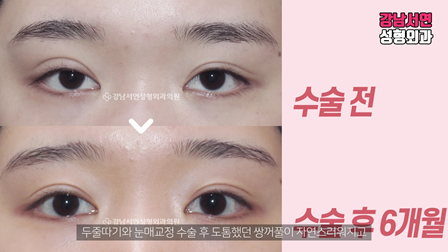 두줄따기 수술 전후 비교 사진