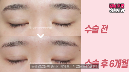 두줄따기 수술 전후 비교 사진