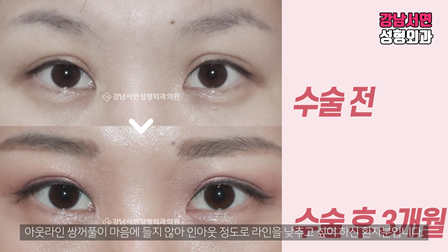 두줄따기 수술 전후 비교 사진