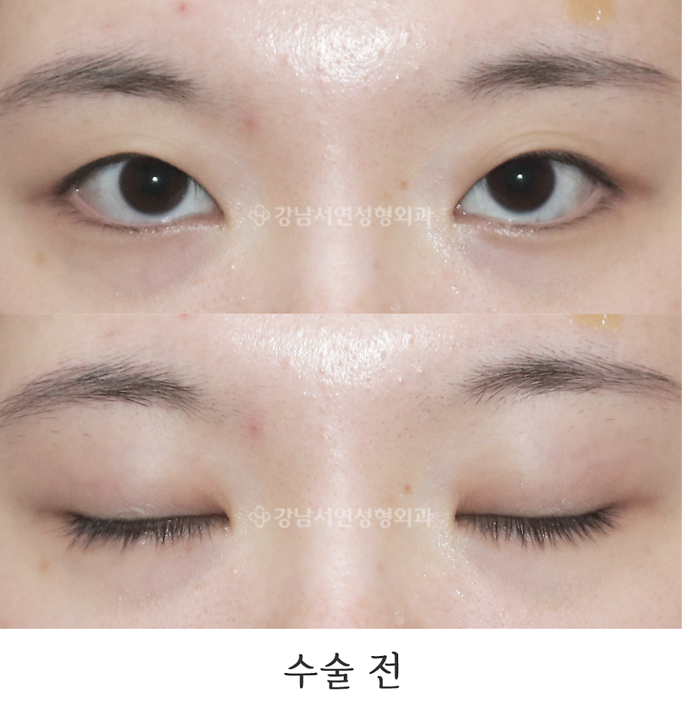 매몰실풀기 수술 전 사진