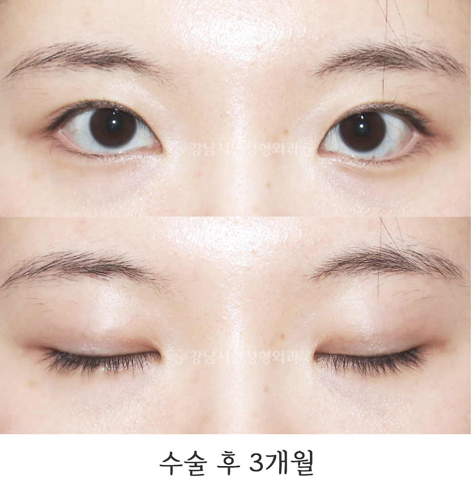 매몰실풀기 수술 후 사진