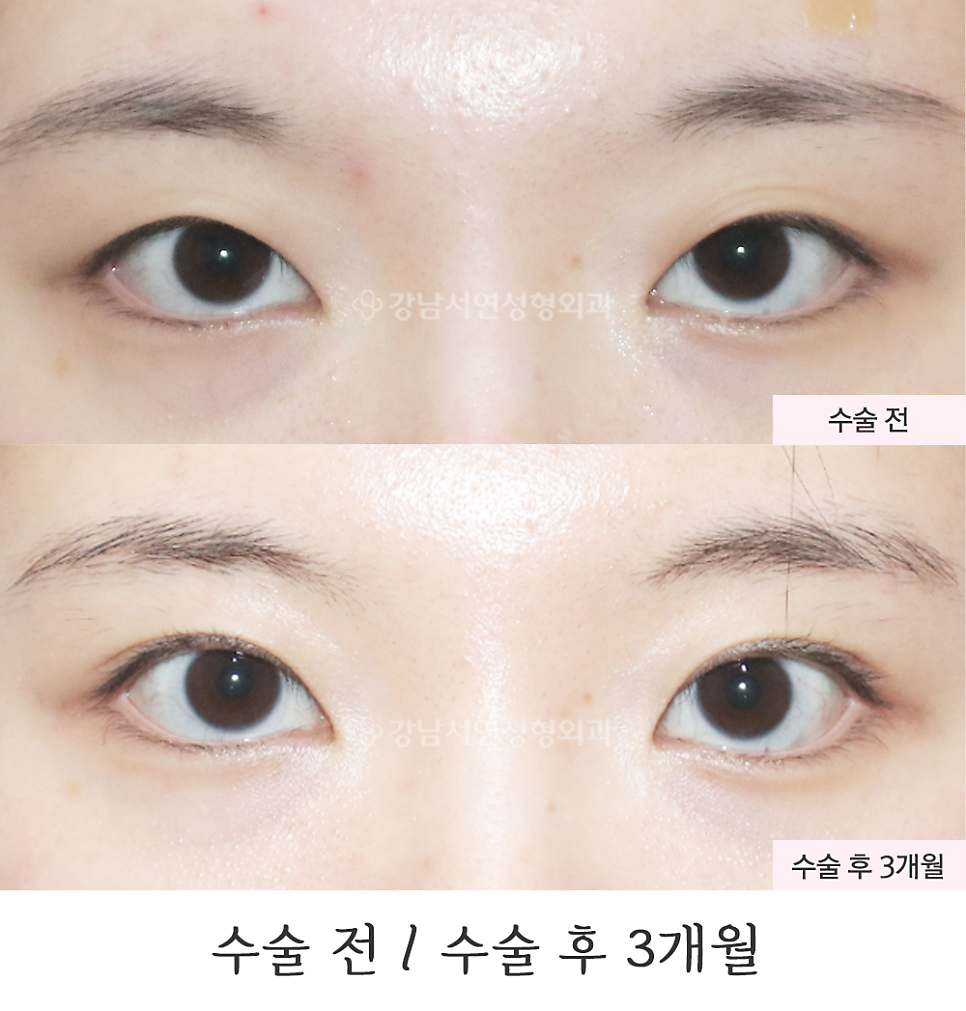 매몰실풀기 수술 전후 비교 사진