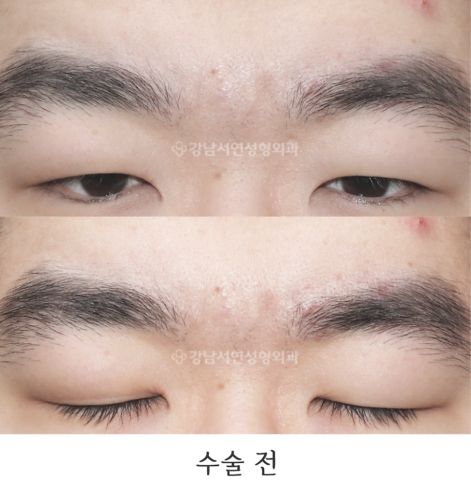 남자 눈성형 수술 전 사진