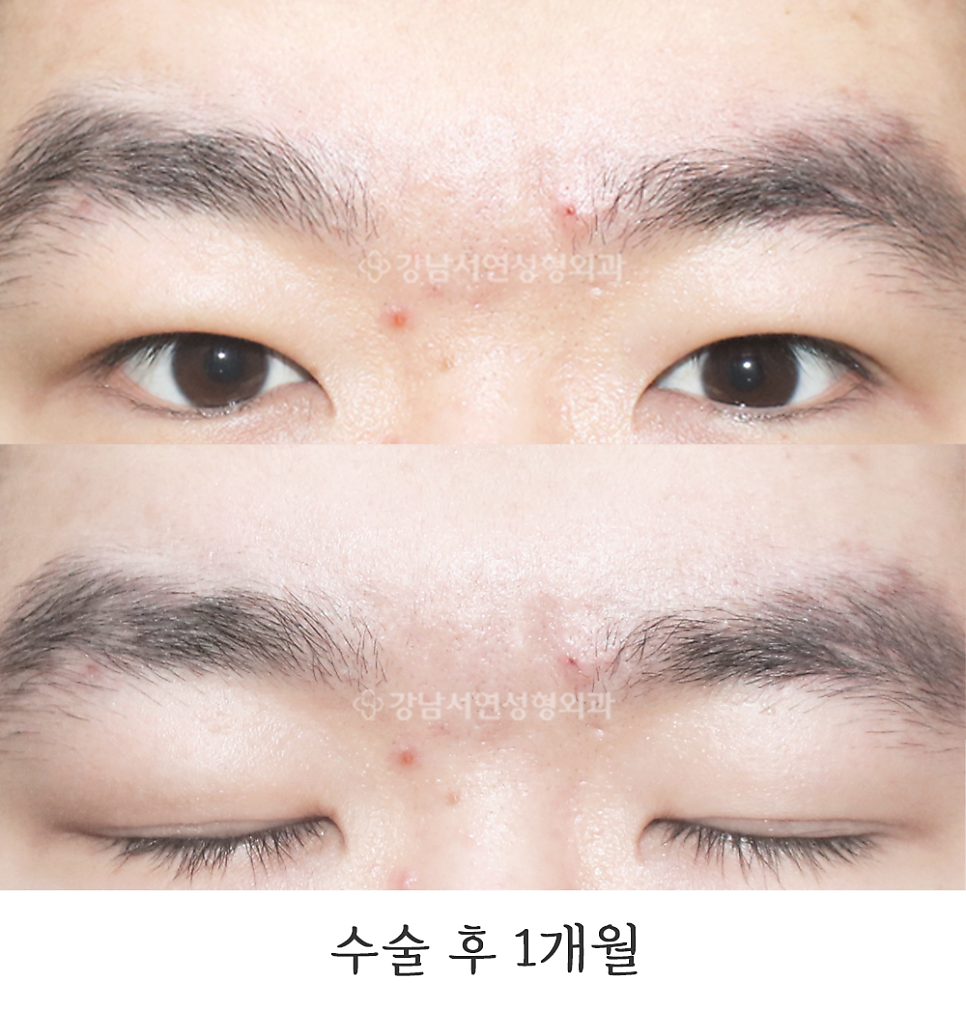 남자 눈성형 수술 후 사진