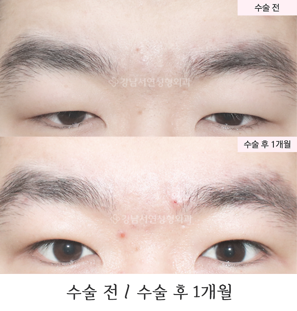 남자 눈성형 수술 전후 비교 사진