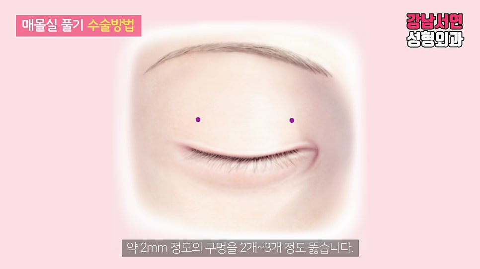 매몰실풀기 설명 도해