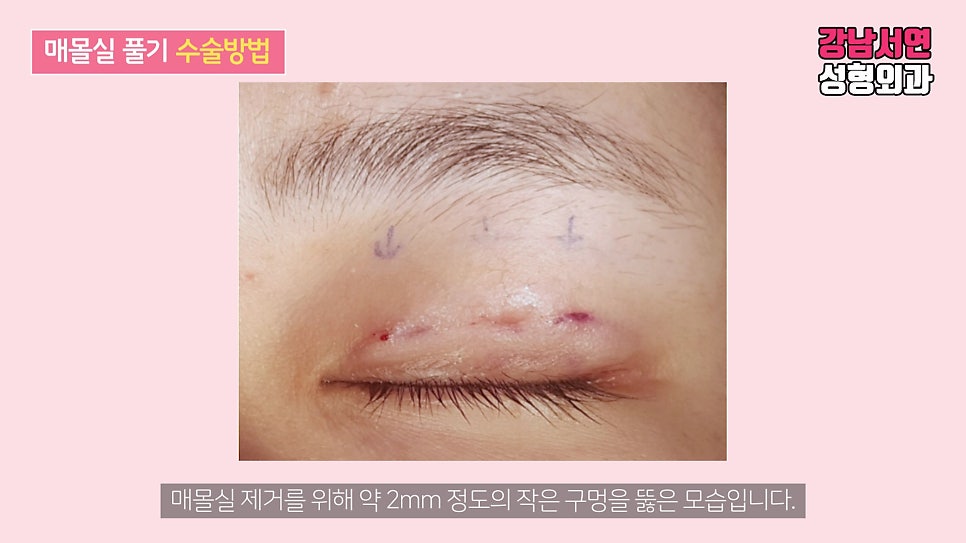 매몰실풀기 수술 장면