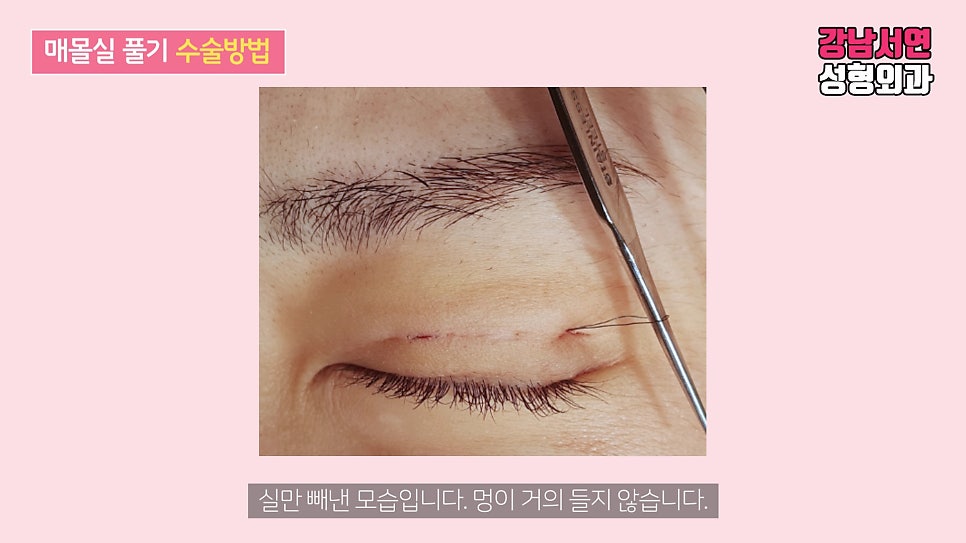 매몰실풀기 수술 장면