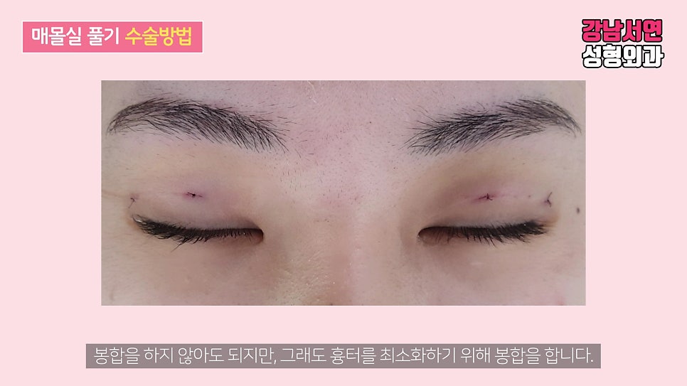 매몰실풀기 수술 장면