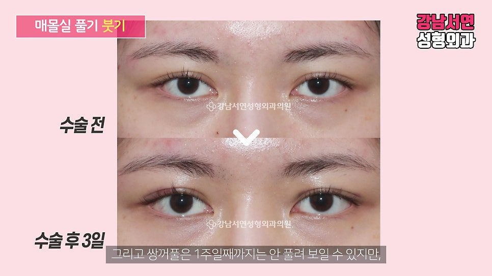 매몰실풀기 수술 전후 비교 사진