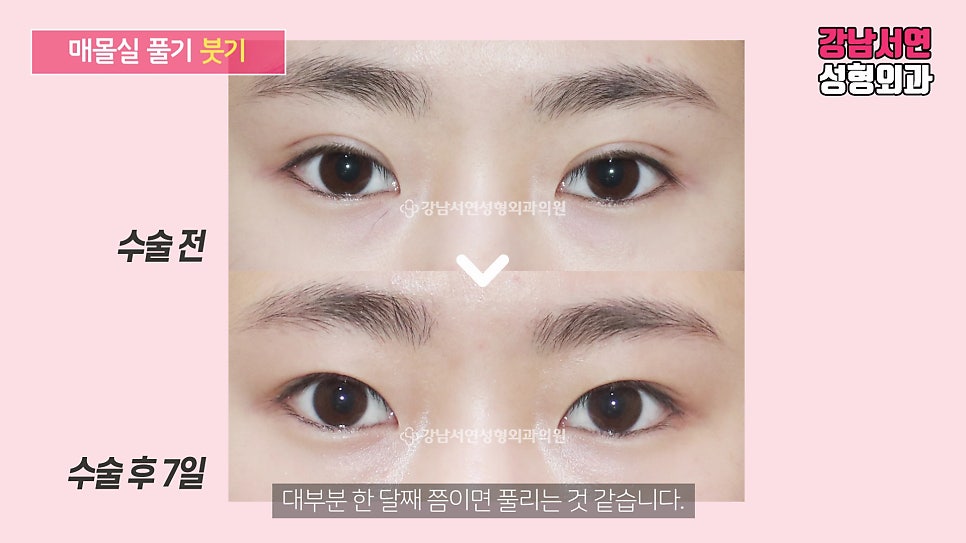 매몰실풀기 수술 전후 비교 사진