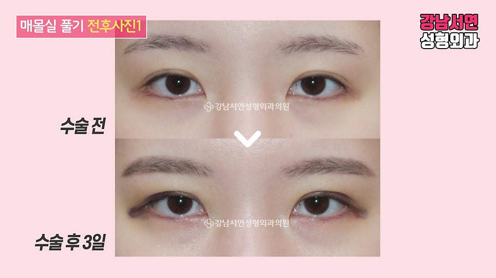 매몰실풀기 수술 전후 비교 사진