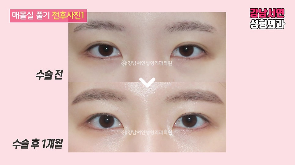 매몰실풀기 수술 전후 비교 사진