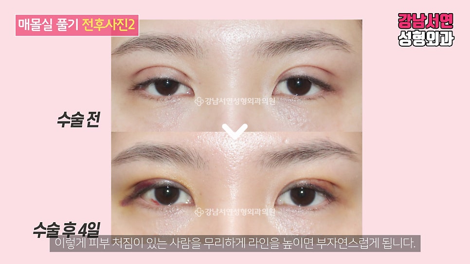 매몰실풀기 수술 전후 비교 사진