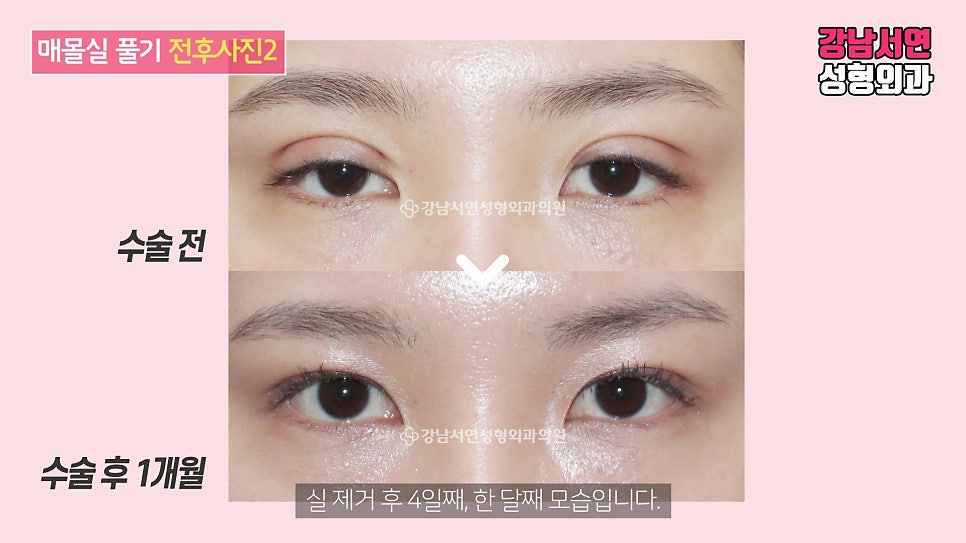 매몰실풀기 수술 전후 비교 사진