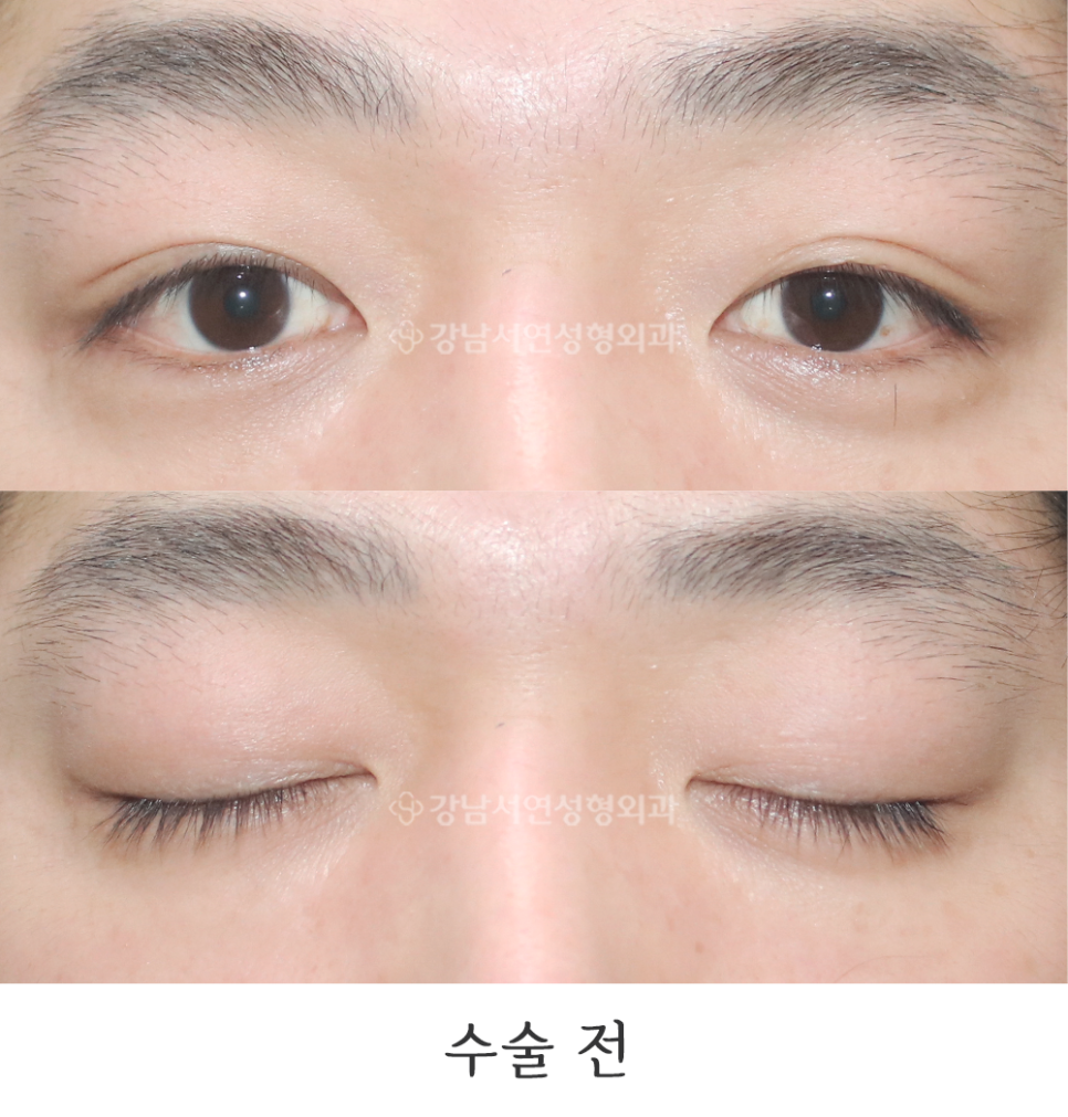 남자 눈성형 수술 전 사진