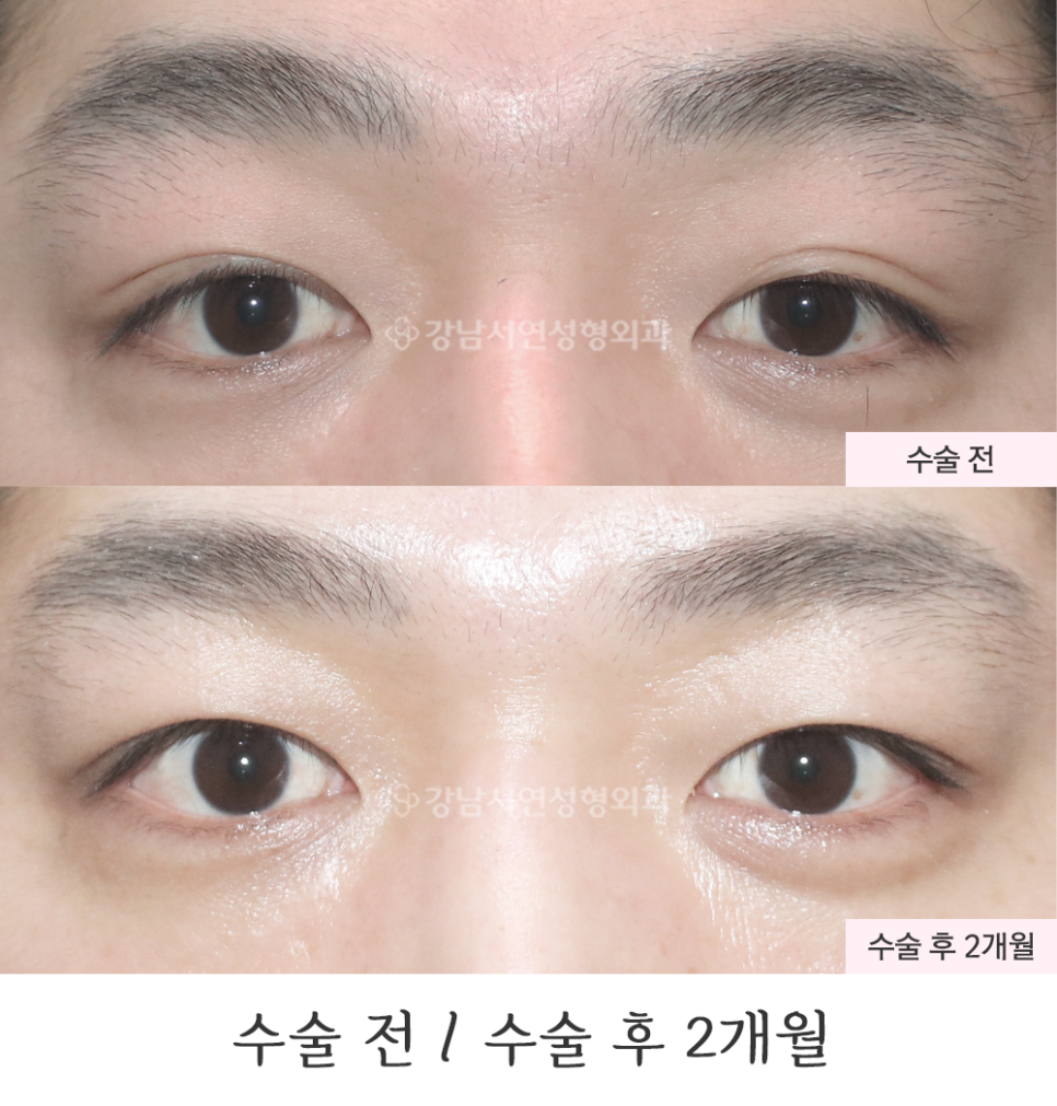 남자 눈성형 수술 전후 비교 사진