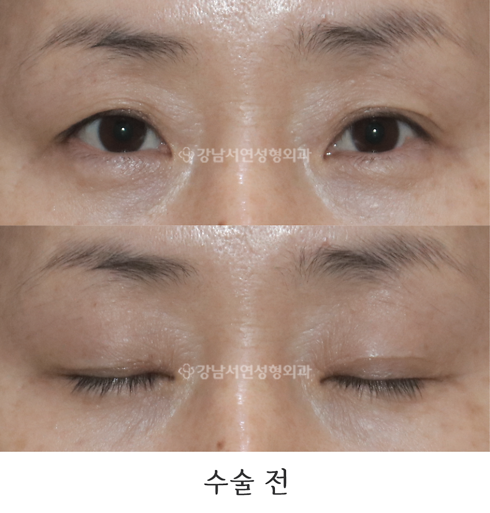 상안검성형 수술 전 사진