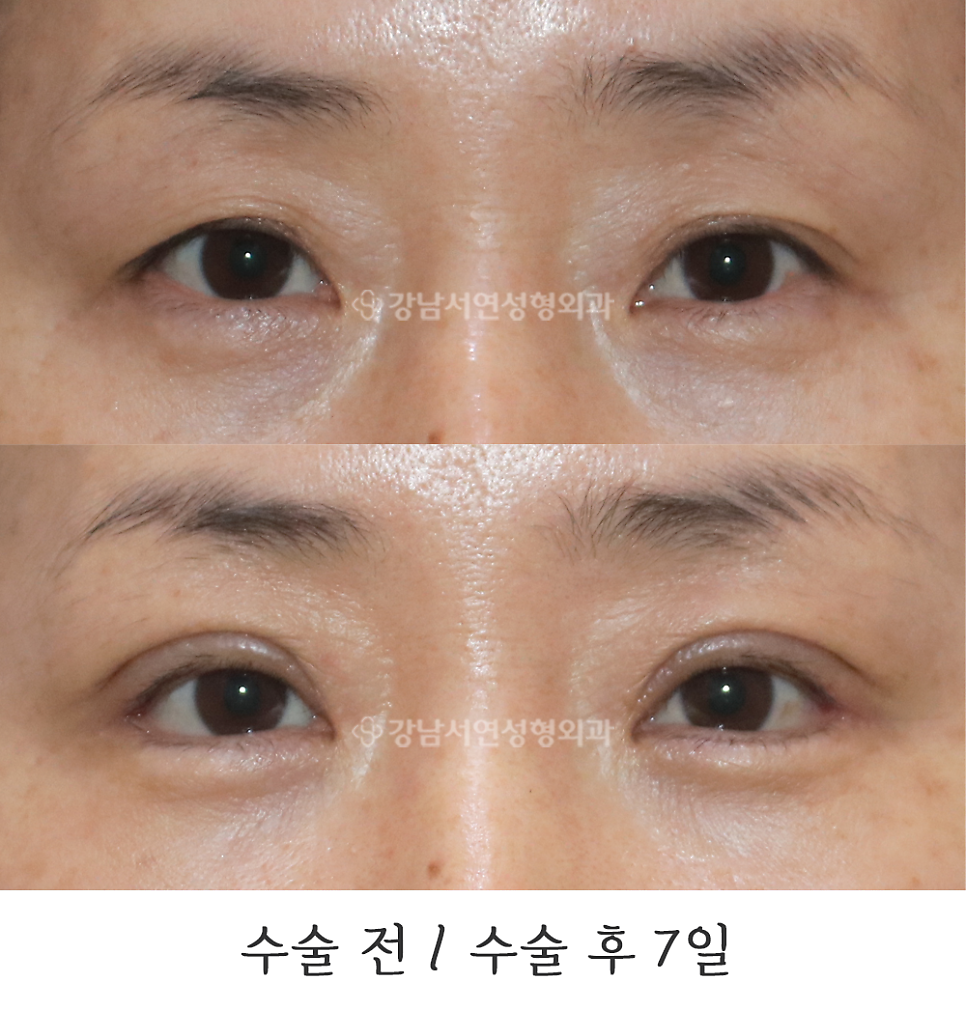 상안검성형 수술 전후 비교 사진
