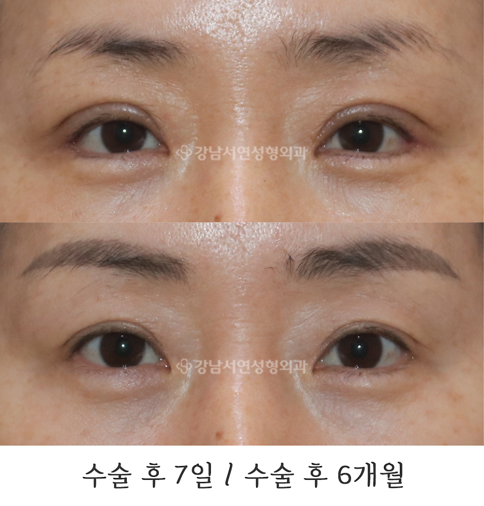 상안검성형 수술 전후 비교 사진