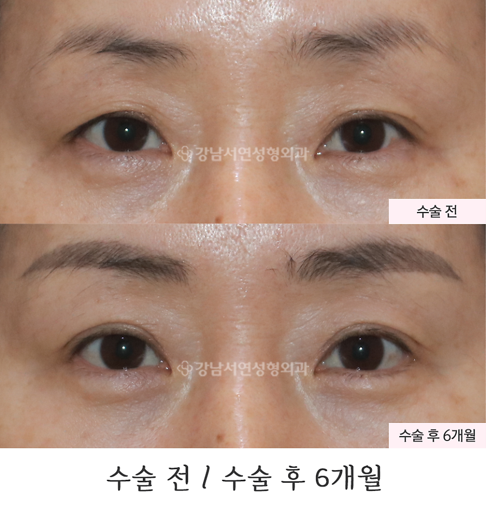 상안검성형 수술 전후 비교 사진
