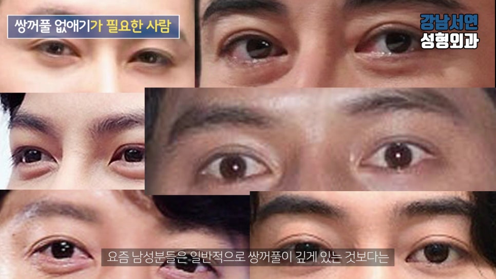 남자 눈성형 수술 사례 눈 사진