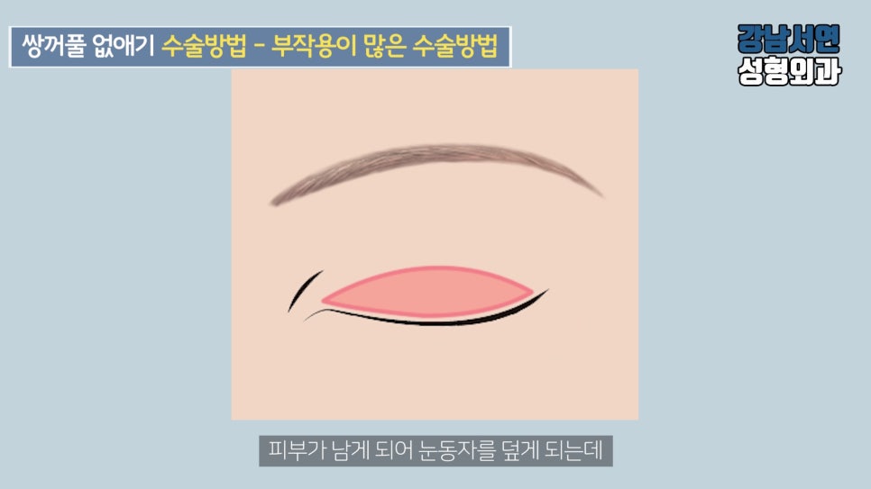 남자 눈성형 설명 도해